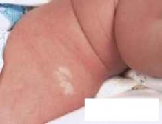 手上出现白斑是什么原因造成