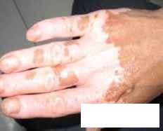 贵州正规的白癜风专科医院