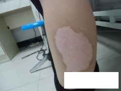 贵州怎么治疗白癜风