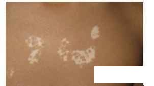 贵州白癜风治疗哪家医院快