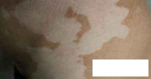 贵州医治白癜风哪儿好