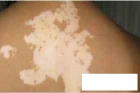 贵州怎样医治白癜风