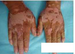 贵州白癜风怎么样治疗