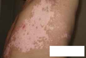 贵州治白癜风哪儿专业