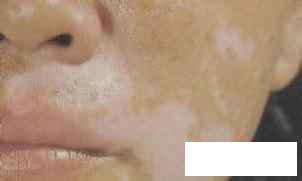 贵州什么地方治疗白癜风