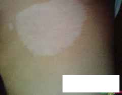 贵州白癜风医院哪治疗好