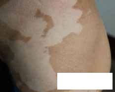 贵州看白癜风哪家好