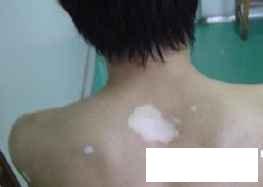 贵州到哪里治疗白癜风好