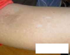 贵州有没有专门看白癜风的医院