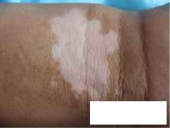 白癜风贵州治疗医院