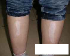 贵州白癜风去哪家治疗好