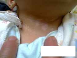 贵州白癜风可不可以治好