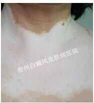 胸部白癜风该如何进行预防呢?