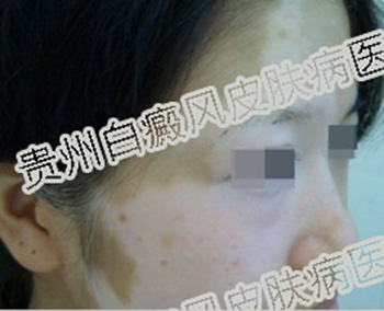 女性白癜风有哪些症状?