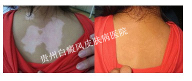 背部白癜风如何治疗效果好
