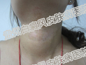 女性的白癜风患者发病有什么特点呢?