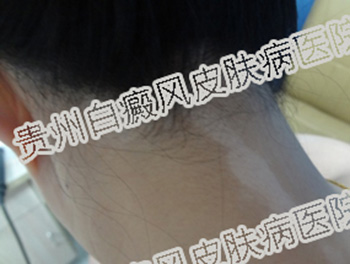 白癜风对女性朋友的影响有哪些?