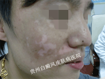 得了面部白癜风需要注意什么?