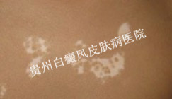 背部白癜风的危害你了解多少
