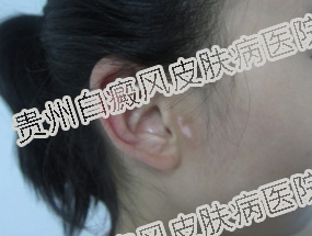 女性白癜风患者最为关心的三大问题