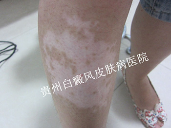 什么原因导致腿部白癜风扩散?