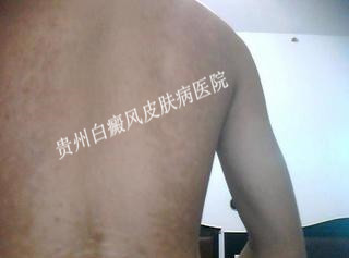 背部白癜风的主要原因是什么