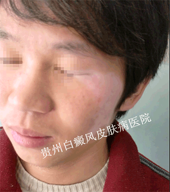 早期面部白癜风的三个特征是什么?