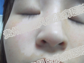 女性患白癜风在怀孕过程中该注意什么?