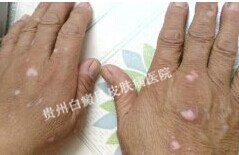 手部白癜风是由什么原因导致的?