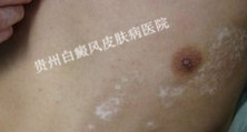 胸部白癜风生活调理