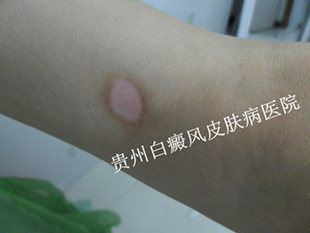 双手白癜风怎样治疗好?