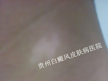 颈部白癜风早期能治好吗
