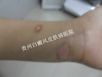 手臂白癜风有哪些早期症状表现?