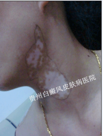 颈部白癜风对患者造成的危害