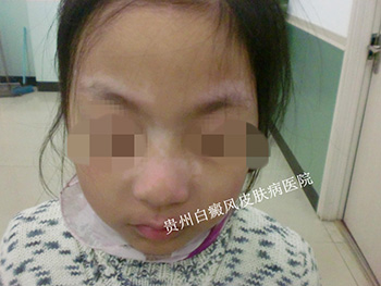面部白癜风如何治疗?