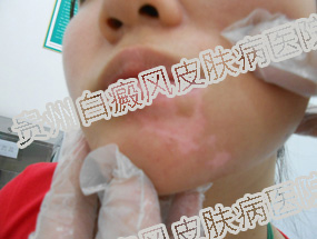 女性白癜风患者怎样调节内分泌?