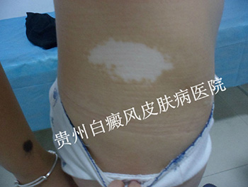如何预防腿部白癜风扩散?