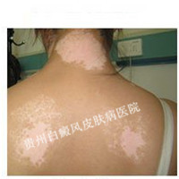 背部白癜风会出现什么症状