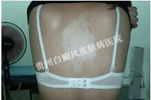 背部白癜风给患者带来的危害