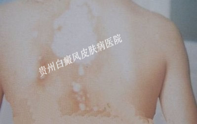 如何防止背部白癜风扩散