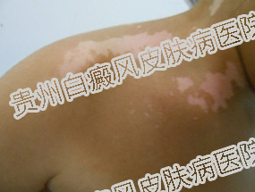 女性白癜风怎么治疗呢?