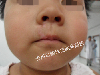 儿童脸上有了白癜风怎么办好?