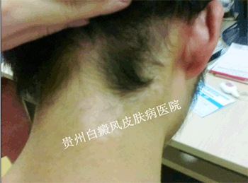 女性颈部白癜风要注意什么