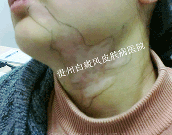 颈部产生白癜风的原因