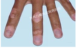 手部为什么易患白癜风