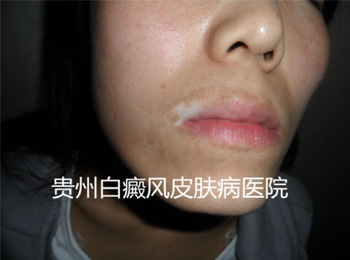 男性得了白癜风有哪些危害?