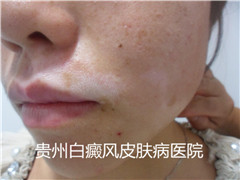 白癜风不治有哪些危害