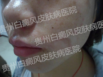 20岁女性颈部白癜风1余年