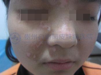 儿童面部、颈部白斑一年半