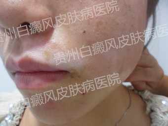 20岁女性颈部白癜风1余年